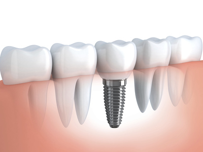 implanty zębów Szczecin